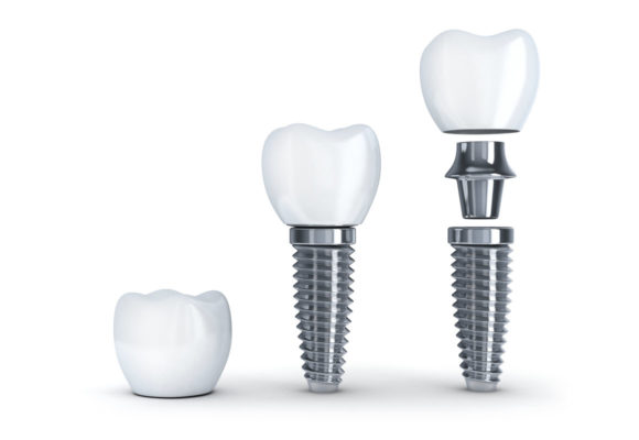 Full Mouth X-Ray (OPG) - Accurate Dental Diagnosis