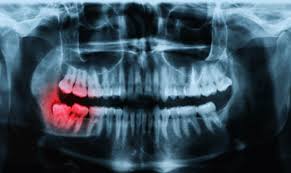 OPG X-Ray - Essential for Comprehensive Oral Health