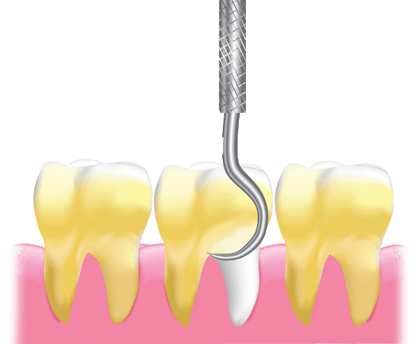 Advanced OPG Scan - Detect Dental Issues Efficiently